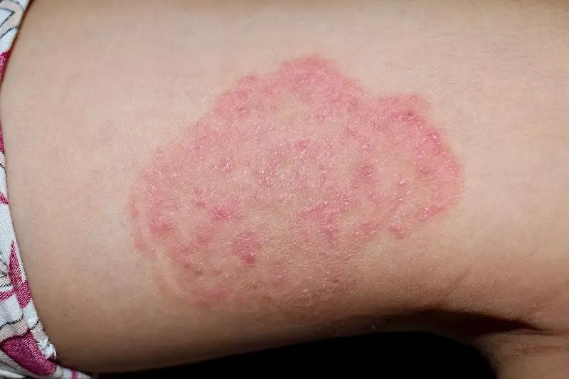What Leads To Signs Of Ringworm And Types